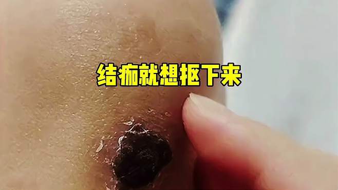 看着心痒痒，结痂就想抠下来